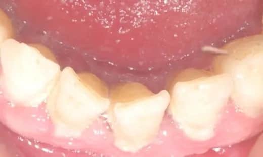 Czy usuwanie kamienia jest na NFZ? Sprawdź, co jest refundowane