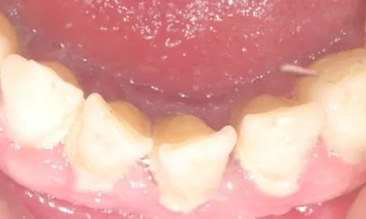 Czy usuwanie kamienia jest na NFZ? Sprawdź, co jest refundowane