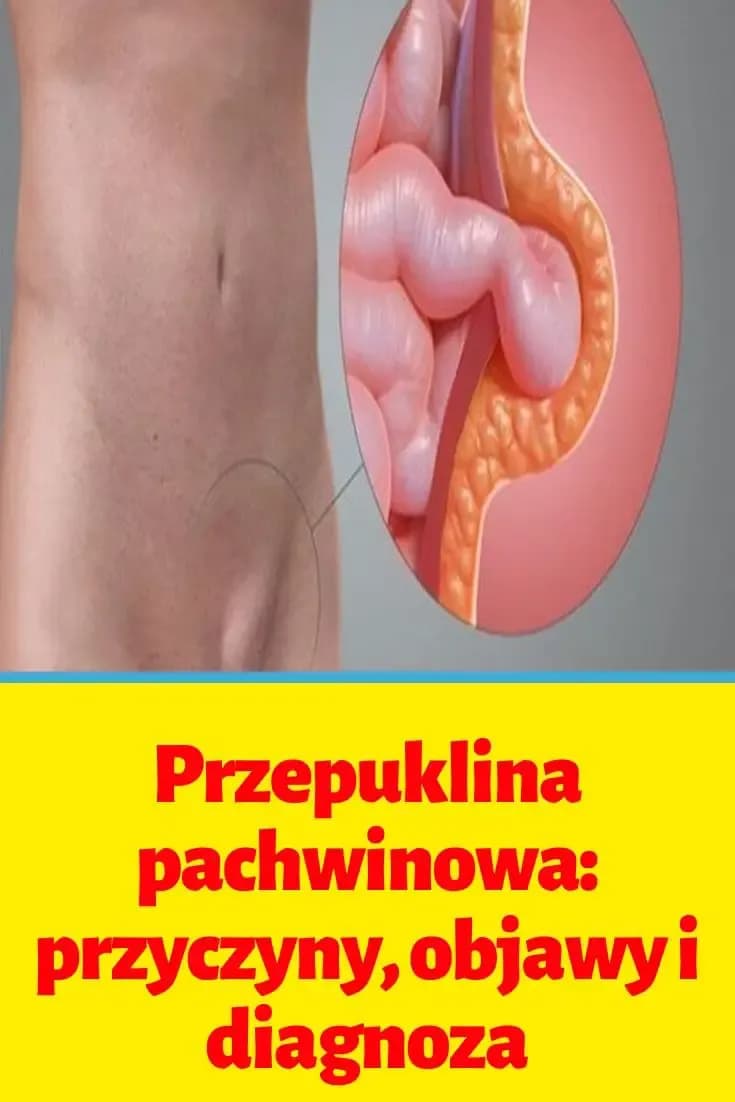 Jakiego lekarza wybrać przy przepuklinie pachwinowej? Dowiedz się teraz